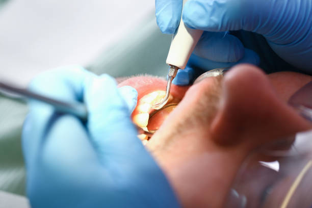 Best Emergency Treatment for Dental Infections or Abscesses in Inglis, FL